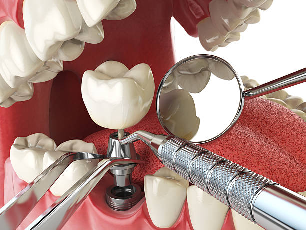 Best Emergency Root Canal Treatment in Graton, CA
